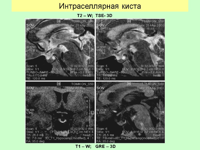 Интраселлярная киста   T2 – W; TSE- 3D T1 – W; GRE –